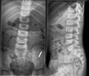 Radiografías simples, proyecciones anteroposterior y lateral de un paciente con una discitis L4-L5 realizadas a los 26 meses después del diagnóstico a la edad de 3 años y 4 meses (mismo paciente que el de las figuras 2 y 3). Se aprecia una disminución del espacio intervertebral, así como esclerosis del platillo superior e inferior.