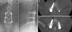A) Rx lumbar postoperatoria; proyecciones AP y lateral. B) TAC lumbar; corte axial L4. C) TAC lumbar; corte axial L5.