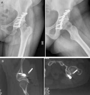 A) Radiología simple anteroposterior y axial de cadera donde se aprecian signos degenerativos, sin aflojamiento del material de osteosíntesis. B) TAC que muestra la zona de protrusión del tornillo (flecha) en vecindad con el nervio ciático.