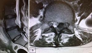 a) Corte sagital de RNM: hernia discal extruida L4-L5 con migración caudal. b) Corte axial de RNM: hernia discal paracentral izquierda que contacta con la raíz y rechaza el saco dural.