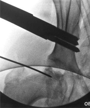 Técnica quirúrgica de artrodiastasis articulada. Control de escopia en el que se observan la aguja guía y los tornillos supraacetabulares.