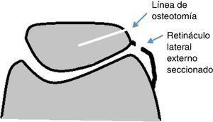 Esquema que muestra la intervención realizada (osteotomía coronal de rótula y sección del alerón rotuliano externo).