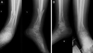 Fractura bilateral: A) Radiografía ántero-posterior y lateral de fractura diafisaria tibial izquierda 42.A2. B) Radiografía ántero-posterior y lateral de fractura de pilón tibial derecho 43.B2.