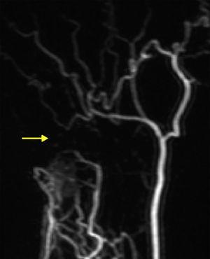 Angiorresonancia tras la inyección de gadolinio: detención brusca del paso de contraste en la arteria cubital al nivel del canal de Guyon. Arterial radial permeable que permite la vascularización digital.