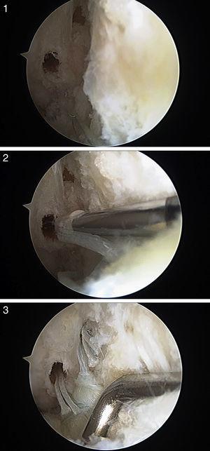 1) Fresado de dos orificios, situados verticalmente en la huella ósea; 2) se pasa el punto de sutura más distal a través de un anclaje sin nudo Biopush Lock de 2,5 mm (Arthrex, Naples, FL) y se introduce en el primer agujero; 3) se emplean 2 implantes ya que permiten una mayor superficie de contacto del LTFA con la huella ósea fibular, así como una mejor distribución de las tensiones, desde un punto de vista biomecánico.
