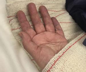 Signos isquémicos de los dedos de las manos tras la luxación del codo.