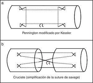 Configuración de la reparación central utilizada para reparación del tendón flexor: a) superficial; b) profundo.