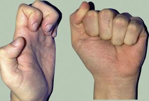 Movilidad activa lograda en paciente (caso 5) con lesión del tendón flexor superficial y profundo en zona 2 del dedo anular.