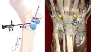 Portales de artroscopia utilizados. Radiocarpianos: 3-4; mediocarpianos: mediocarpiano ulnar (MC-u) y radial (MC-r). El MC-u se utiliza para introducir la óptica y el MC-r como portal de trabajo.