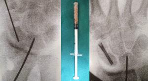 Defecto creado en el escafoides, aporte de injerto del radio distal usando una jeringa de insulina a modo de trocar y resultado intraoperatorio con el tornillo de fijación.