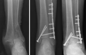 Secuencia de fractura luxación, osteosíntesis y pérdida de reducción.