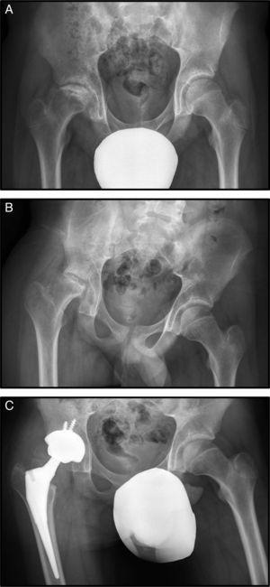 A) Rx AP de pelvis, donde se observa una NAV de cabeza femoral derecha estadio IV de Steinberg. B) Imagen radiográfica donde se aprecia la coxartrosis avanzada al año del diagnóstico. C) Rx AP de pelvis tras la colocación de una prótesis total de cadera a los 16 años.