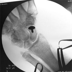 La imagen radiográfica intraoperatoria confirma la adecuada colocación del implante.