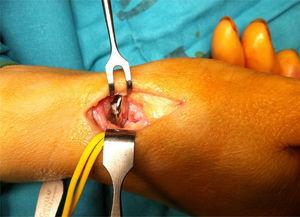Colocación del implante en la articulación escafotrapeciotrapezoidea con anclaje a nivel del escafoides.