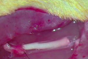 Imagen intraoperatoria de la implantación de la prótesis de nervio acelular con un tubo de ??-CPL (G2).