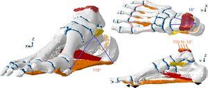 Modelo propuesto para evaluar el efecto de la osteotomía de calcáneo sobre los tejidos pasivos encargados de sostener el arco plantar.