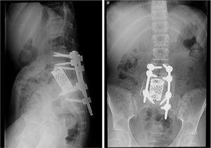 Paciente B. Resultado posquirúrgico: corpectomía L5+fijación posterior.