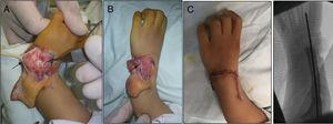 A. Apertura de la articulación del carpo y preparación de la centralización del carpo en el extremo distal del cúbito, con flecha negra el carpi ulnaris (ECU). B. Se han suturado los tejidos capsuloligamentarios del carpo, se ha acortado el ECU y se ha transferido el extensor radial hacia el ECU. C. Finalmente resultado clínico y radiológico inmediato.