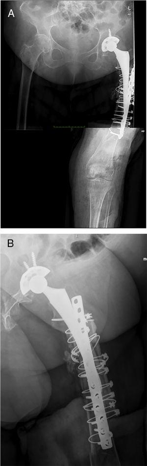 Imagen radiográfica en proyecciones anteroposterior (A) y lateral (B) de uno de los pacientes intervenidos mediante esta técnica quirúrgica.