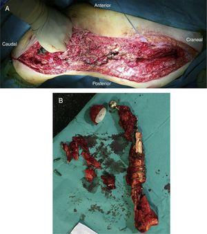 (A) Lecho quirúrgico tras la resección del implante y restos de fémur. (B) Pieza tras la resección.