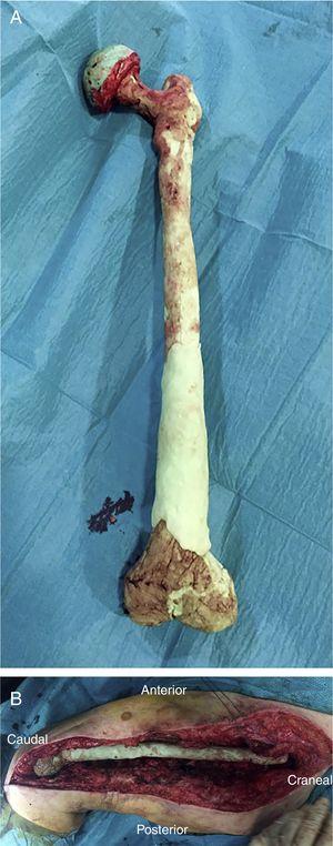 Espaciador femoral biarticulado (A) y su reducción en el lecho quirúrgico (B).