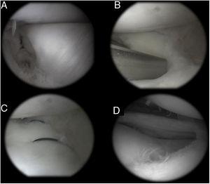 Imágenes artroscópicas del tratamiento: A) Presentación inicial; B) Luego de la remodelación, realizando la fijación periférica con puntos dentro-fuera; C) Luego de la fijación; D) Aspecto final.