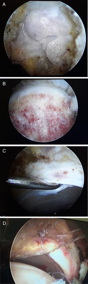 A. Imagen de la deformidad tipo cam mediante CAC. B. Imagen tras realizar femoroplastia mediante CAC. C. Detección de lesión de labrum mediante CAC. D. Sutura de labrum mediante anclajes.