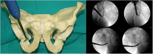 Segunda osteotomía; fosa infracetabular, 1cm ventral a la corteza de isquion posterior. Supervisado por radiografías antero-posterior y Lequesne.