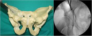 Cuarta osteotomía, ala ilíaca inmediatamente debajo de la espina iliaca antero-superior hacia 1cm del borde pélvico. Supervisado por la proyección de pelvis AP.