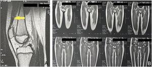 Resonancia magnética tomada a los 12 años de edad. A) Muestra la ruptura traumática de la unión miotendinosa distal del músculo recto femoral (señalada con la flecha). B) No se observan alteraciones en la zona media y proximal del cuádriceps.