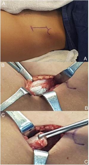 A) Cresta iliaca anterosuperior como punto anatómico durante el abordaje anterior. B) Hipertrofia del tendón del músculo recto anterior visualizada. C) Tenotomía proximal del recto anterior.