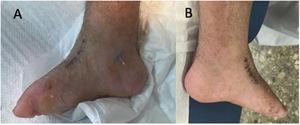 Pie derecho A y pie izquierdo B, tras la retirada del último yeso en el paciente con síndrome Cornelia de Lange.