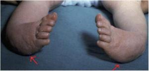 Pie zambo sindrómico bilateral, en el que se aprecia otro de los signos de la clasificación de Pirani: borde lateral curvado.