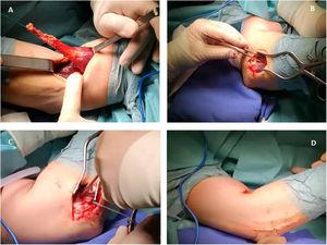 A) Preparación y aislamiento del tendón distal. B) Abordaje lateral y exposición de la tuberosidad radial. C) Anclaje del tendón. D) Sutura final.