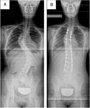 Paciente 1. A) Radiografía posteroanterior preoperatoria. B) Radiografía posteroanterior postoperatoria.