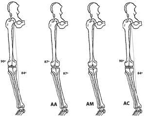Rodilla nativa en varo y alineación anatómica (AA), mecánica (AM) y cinemática (AC). Se observa la diferente orientación y grosor de la osteotomía tibial y femoral entre los tres tipos de alineación.