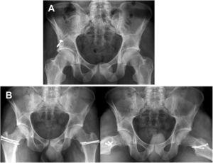 Imágenes pre y postoperatorias de un PFA de tipo mixto. A) Imagen radiológica AP de un paciente varón de 22 años con PFA sintomático bilateral de tipo mixto; Tönnis grado 0. B) Proyecciones AP y de rana 30 (cadera izquierda) y 36 (cadera derecha) meses después de LQC para el tratamiento de PFA mixto que muestra corrección completa de deformidades con osteocondroplastia acetabular y femoral. El labrum no fue reparado debido a la osificación bilateral.