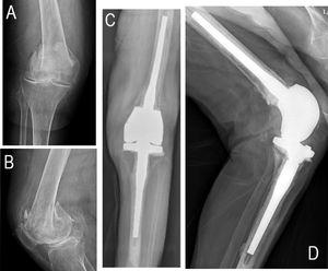(A and B) Anteroposterior and lateral X-ray images demonstrating a supraintercondylar femoral fracture (type 33-C3 in the AO/OTA classification). (C and D) Anteroposterior and lateral post-operative X-ray images showing a correct implantation of the arthroplasty.