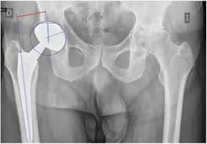 Cálculo radiográfico del offset femoral en la cadera intervenida.