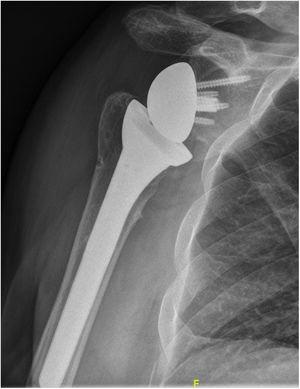 Radiographic image of scapular notching showing erosion at the glenoid neck caused by impingement against the humeral component.