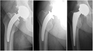 First case of aseptic femoral loosening, treated by revision and replacement with a standard stem.