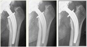 Second case of aseptic femoral loosening, treated by revision and replacement with a larger short stem.