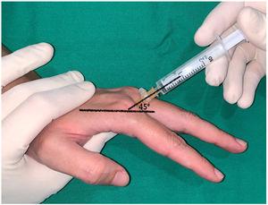 Dorsal web space injection performed on the index finger keeping the metacarpophalangeal joint slightly flexed and directing the needle towards the metacarpal head at an angle of 45 with respect to the axis of the metacarpal.