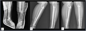 Patient with a transverse fracture of the distal tibia (a) treated with an intramedullary nail who after 4 months had delayed healing (b), so it was decided to dynamise the system to obtain healing (c).