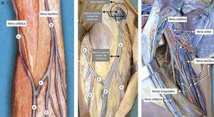 3a: pieza anatómica de las venas del codo y del brazo: vena cefálica (a), vena basílica (b), vena intermedia del codo (c), vena intermedia del antebrazo (d). 3b: la vena basílica perfora la fascia profunda por el hiato basílico junto con el nervio cutáneo medial del antebrazo. 3c: relación entre las venas del brazo.