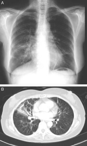 Radiografía de tórax (A) y TAC torácica con contraste (B) al inicio del estudio.