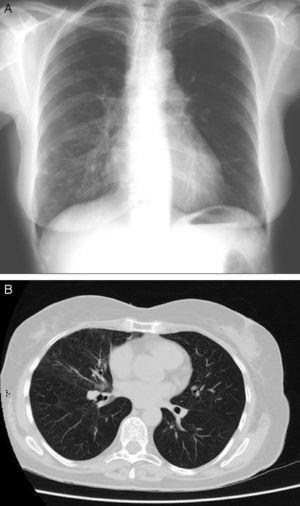 Radiografía de tórax (A) y TAC torácica de alta resolución (B) tras la suspensión de la nitrofurantoína.
