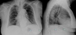 Radiografías posteroanterior y lateral del tórax. Se aprecia una lesión nodular calcificada infradiafragmática izquierda (flechas).