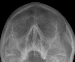 Radiografía de los senos paranasales. Ocupación del seno frontal izquierdo y de ambos senos maxilares.