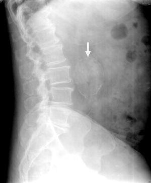 Radiografía de columna lumbosacra (vista lateral) donde se observa la dilatación sacular calcificada aneurismática de la aorta.